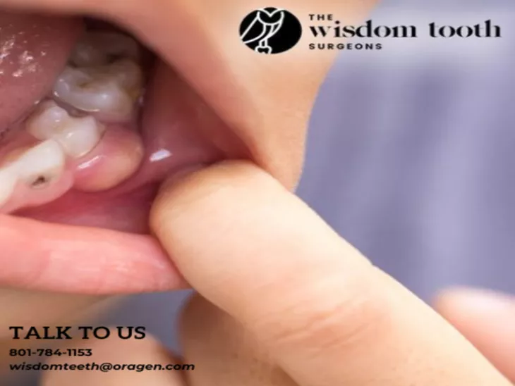 wisdom tooth surgeons utah