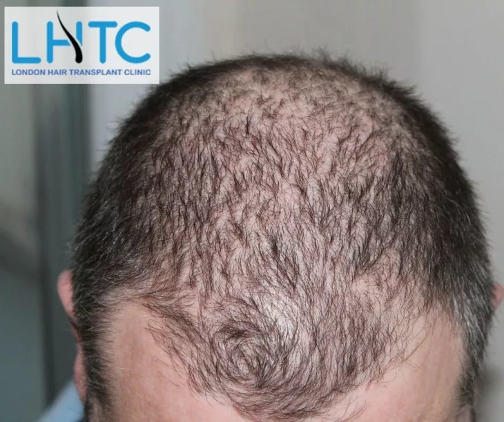 Want to connect with a relevant Hair Transplant Clinic in London to manage your hair loss!