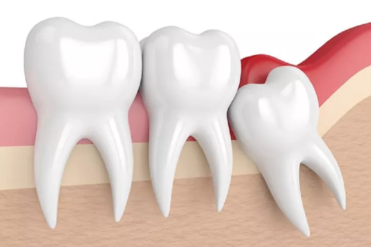 Wisdom Tooth Removal in Olney